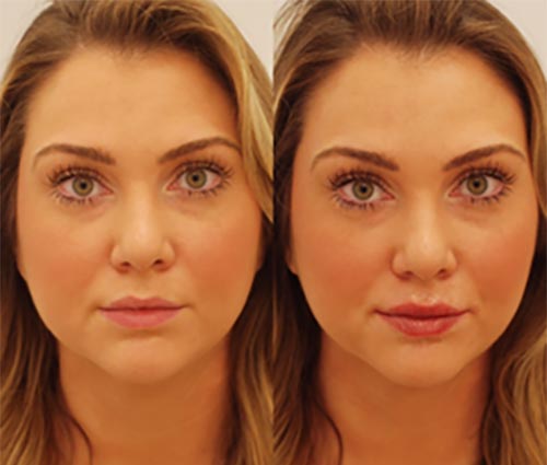 Facial Balancing with Fillers Near Me in Lake Zurich IL