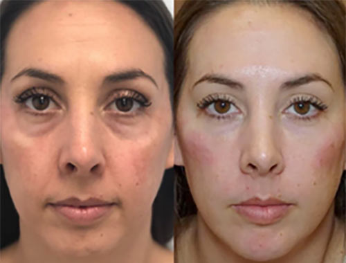 Facial Balancing with Fillers Near Me in Lake Zurich IL