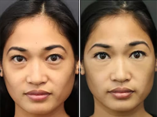 Facial Balancing with Fillers Near Me in Lake Zurich IL