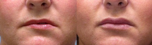 Lip Fillers Lip Fillers