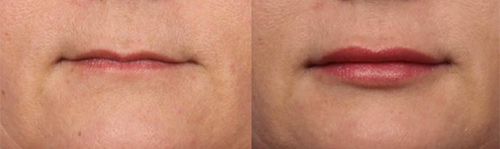 Lip Fillers Lip Fillers