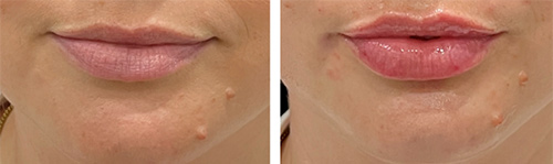 Lip Fillers Lip Fillers
