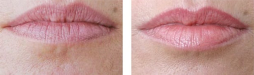 Lip Fillers Lip Fillers