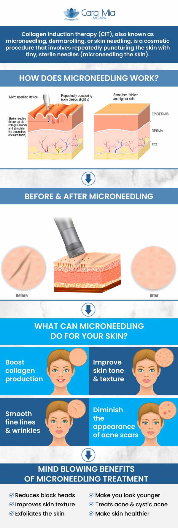 Experience the benefits of Collagen Stimulation at Cara Mia Medspa. Our medical professionals offer an effective Microneedling treatment for aging skin, wrinkles, pores & scars. For more information, call us or schedule an appointment online. We serve clients from Lake Zurich IL, Barrington IL, Kildeer IL, Deer Park IL, Tower Lakes IL, and Hawthorn Woods IL.