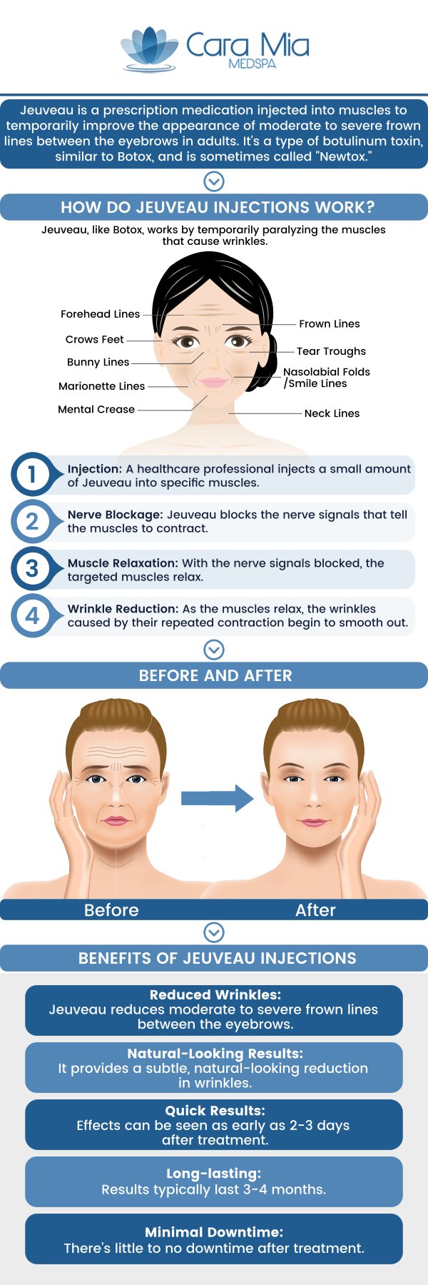 Jeuveau is an FDA-approved injectable botulinum toxin treatment that temporarily reduces fine lines and wrinkles. It inhibits nerve transmission, causing the muscles to relax. Jeuveau is primarily used to eliminate crow's feet between the eyebrows and it may be appropriate for people with crow's feet, frown lines, broad jaws, and sagging brows. Jeuveau can help improve the appearance of many facial areas. If you want to boost your looks, you have come to the right clinic! At Cara Mia Medspa our specialists offer Jeuveau. For more information, contact us or book an appointment online. We are located at 303 N Rand Rd, Lake Zurich, IL 60047. Jeuveau is an FDA-approved injectable botulinum toxin treatment that temporarily reduces fine lines and wrinkles. It inhibits nerve transmission, causing the muscles to relax. Jeuveau is primarily used to eliminate crow's feet between the eyebrows and it may be appropriate for people with crow's feet, frown lines, broad jaws, and sagging brows. Jeuveau can help improve the appearance of many facial areas. If you want to boost your looks, you have come to the right clinic! At Cara Mia Medspa our specialists offer Jeuveau. For more information, contact us or book an appointment online. We are located at 303 N Rand Rd, Lake Zurich, IL 60047.